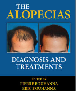 The Alopecias: Diagnosis and Treatments