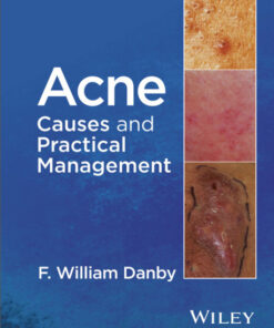 Acne: Causes and Practical Management 1st Edition