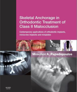 Ebook Skeletal Anchorage in Orthodontic Treatment of Class II Malocclusion: Contemporary applications of orthodontic implants, miniscrew implantsand mini plates, 1e