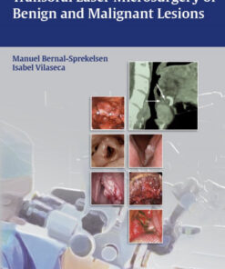 Transoral Laser Microsurgery of Benign and Malignant Lesions 1st edition