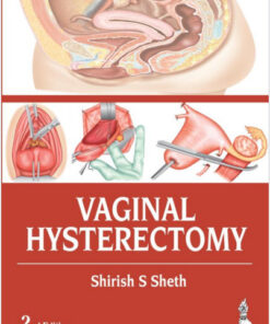 Vaginal Hysterectomy 2nd Edition