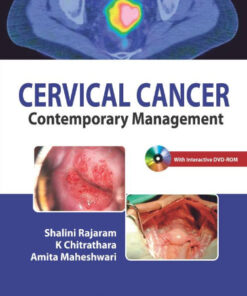 Cervical Cancer: Contemporary Management