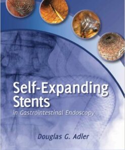 Self-Expanding Stents in Gastrointestinal Endoscopy 1st Edition