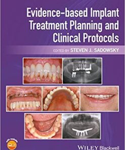Evidence-Based Implant Treatment Planning and Clinical Protocols