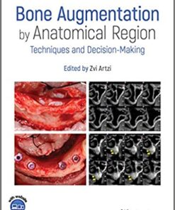 Bone Augmentation by Anatomical Region: Techniques and Decision-Making 1st Edition PDF