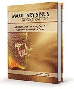 Maxillary Sinus Bone Grafting: A Picture Atlas Featuring over 50 Complete Step-By-Step Cases PDF