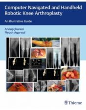 Computer Navigated and Handheld Robotic Knee Arthroplasty: An Illustrative Guide is a compendium of principles and practices of using technology to improve outcomes of partial and total knee arthroplasty.